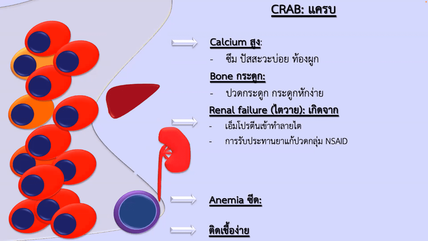 CRAB อาการของมะเร็ง MM (มะเร็งเม็ดเลือดขาว มัลติเพิล มัยอิโลมา)